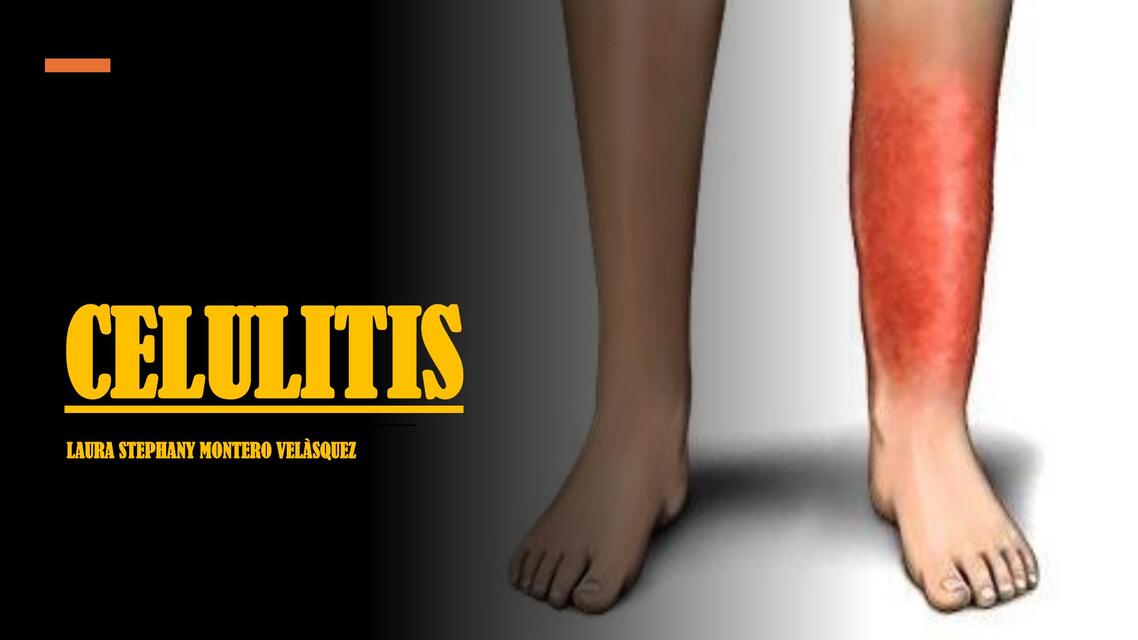 CELULITIS PEDIATRICA EXPOSICION