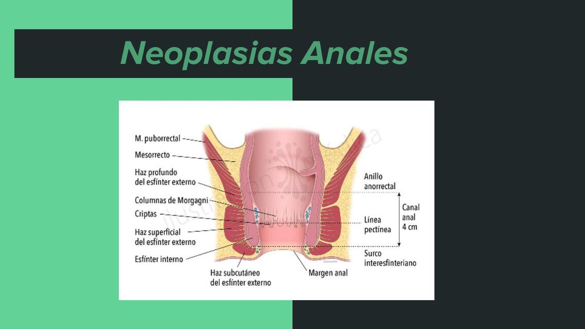 Neoplasias anales