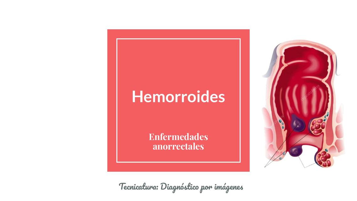 Hemorroides