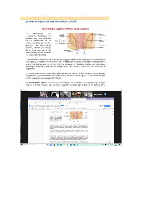 CASO CLINICO PATOLOGÍA ANORECTAL BENIGNA