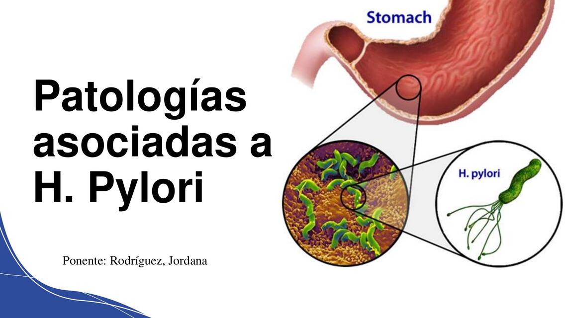 Patologías asociadas a H. Pylori