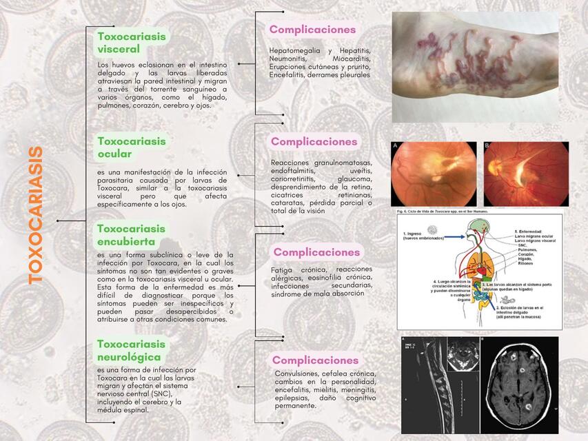 TOXOCARIASIS TIPOS - CUADRO SINÓPTICO