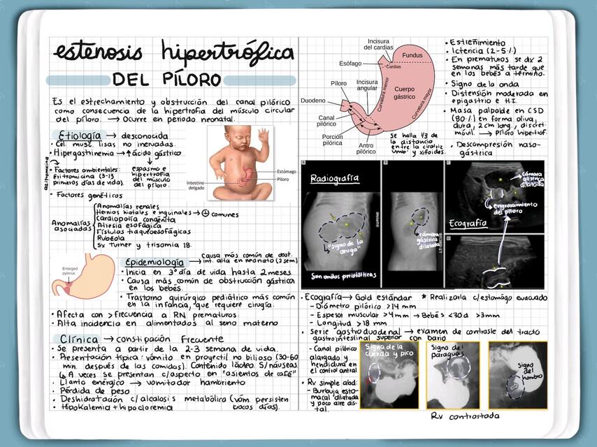 Estenosis hipertrófica del píloro