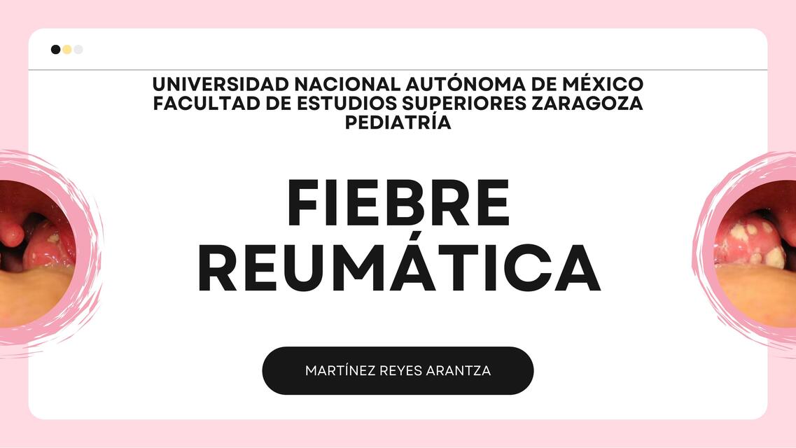 FIEBRE REUMÁTICA