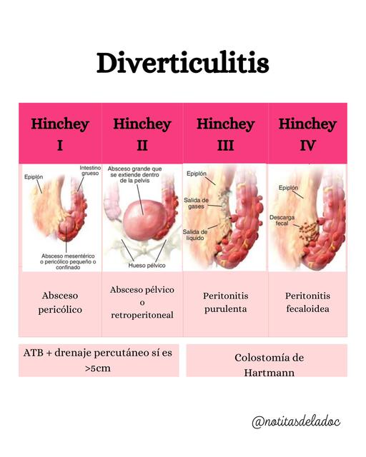 Diverticulitis