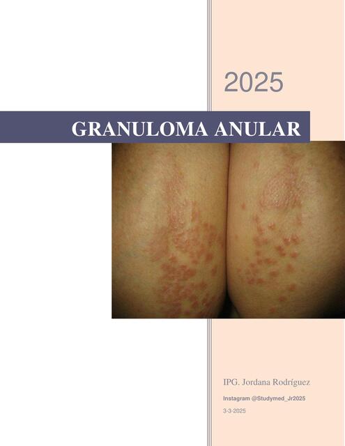 GRANULOMA ANULAR