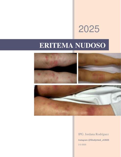 ERITEMA NUDOSO