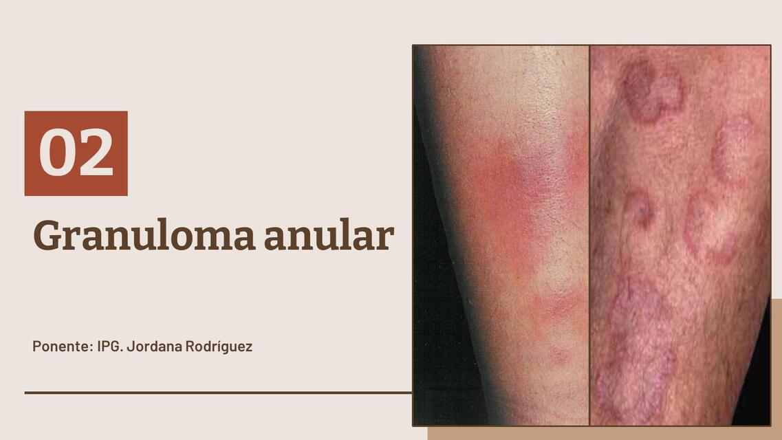 GRANULOMA ANULAR