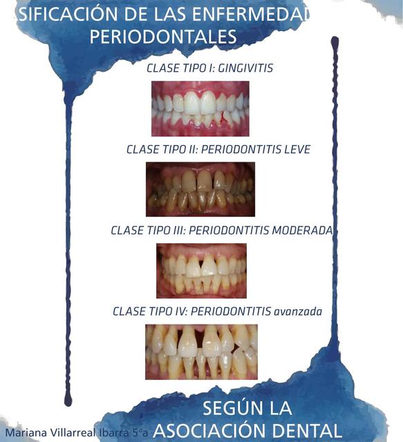 Clasificación Periodontitis 