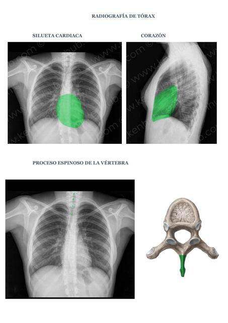 RADIOGRAFÍA TÓRAX COMPONENTES