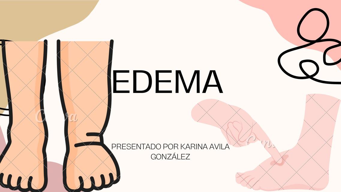 EDEMA