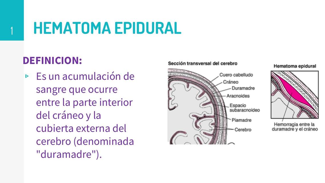 Hematoma Epidural