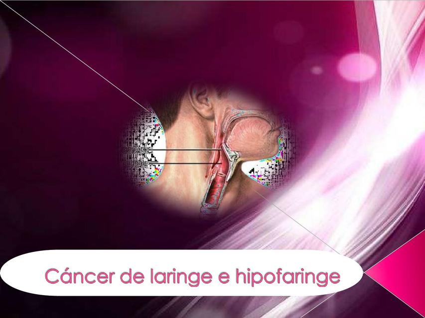 Cáncer de laringe e hipofaringe