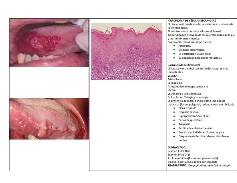 Carcinoma De CÉlulas Escamosas PÉnfigo Vulgar Leucoplasia Pénfigo Leucoplasia Udocz