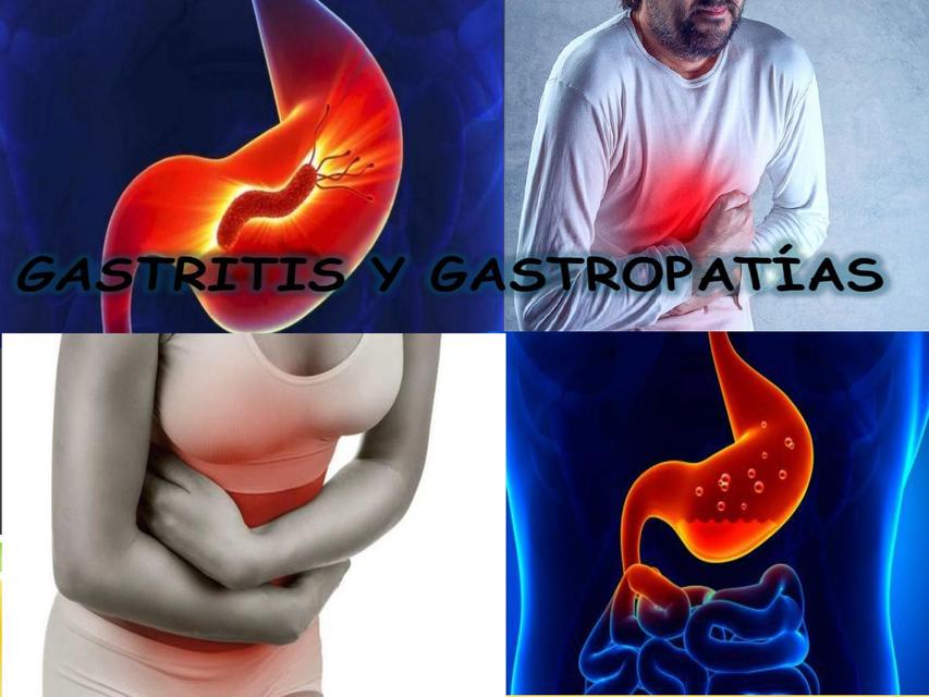 Gastritis y Gastropatía | Dra.xmed☞📚🔬📄📒📓📔📕📖📘📔📑📙 | uDocz