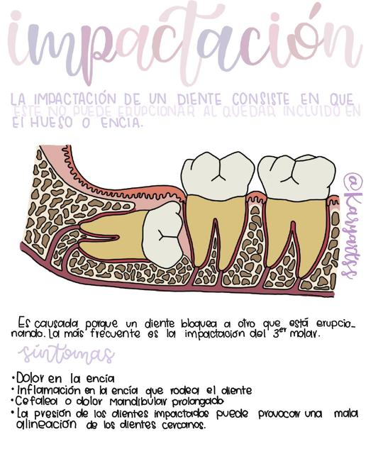 Impactación Dental 