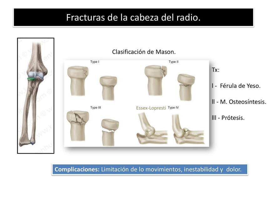 Fracturas de la cabeza del radio | Gabriel | uDocz