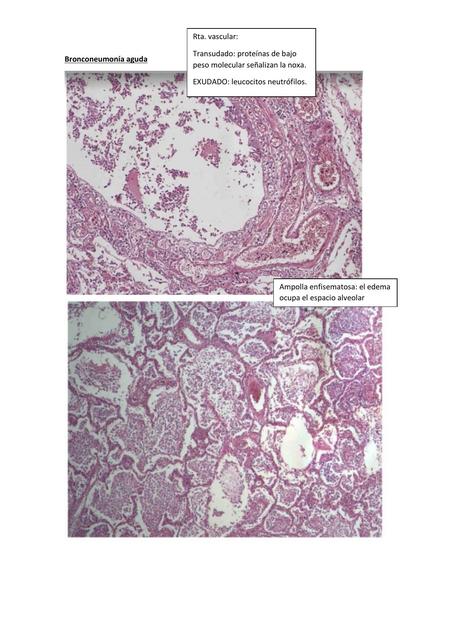  Bronconeumonia Aguda y Apendicitis aguda