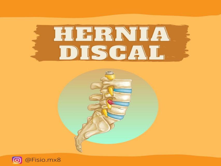 Hernia Discal