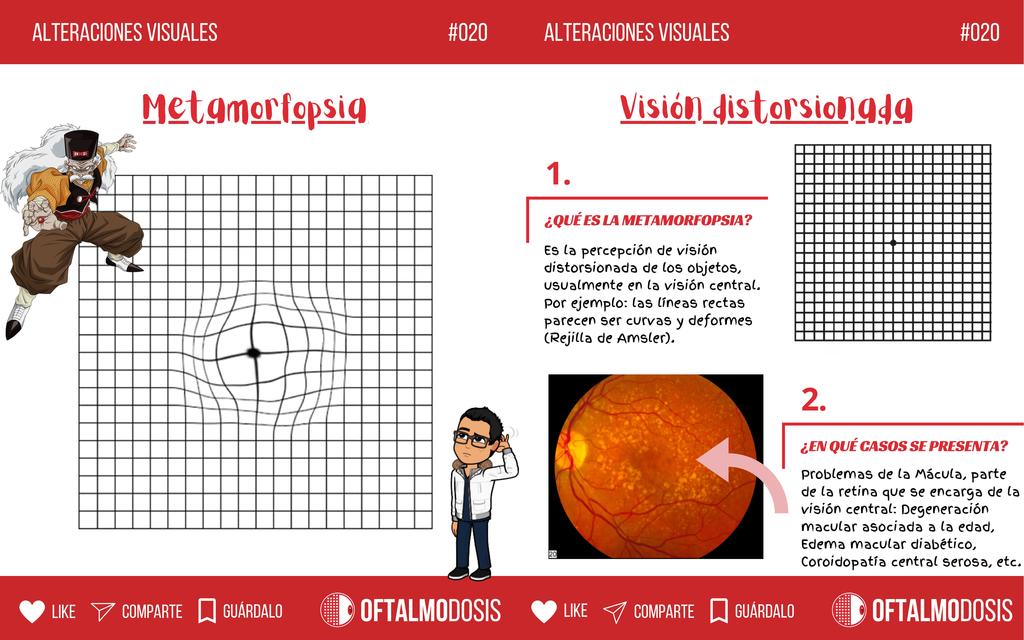 FLASHCARD de oftalmología 020 METAMORFOPSIA