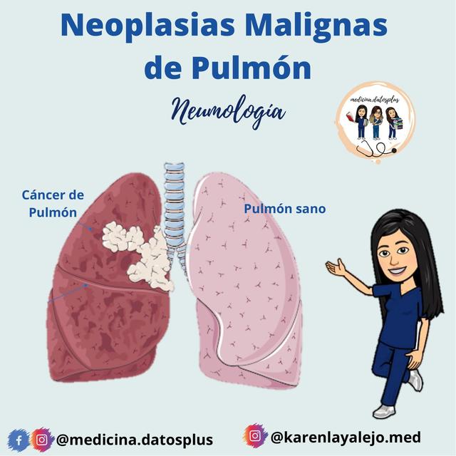 Neoplasias Malignas de Pulmon