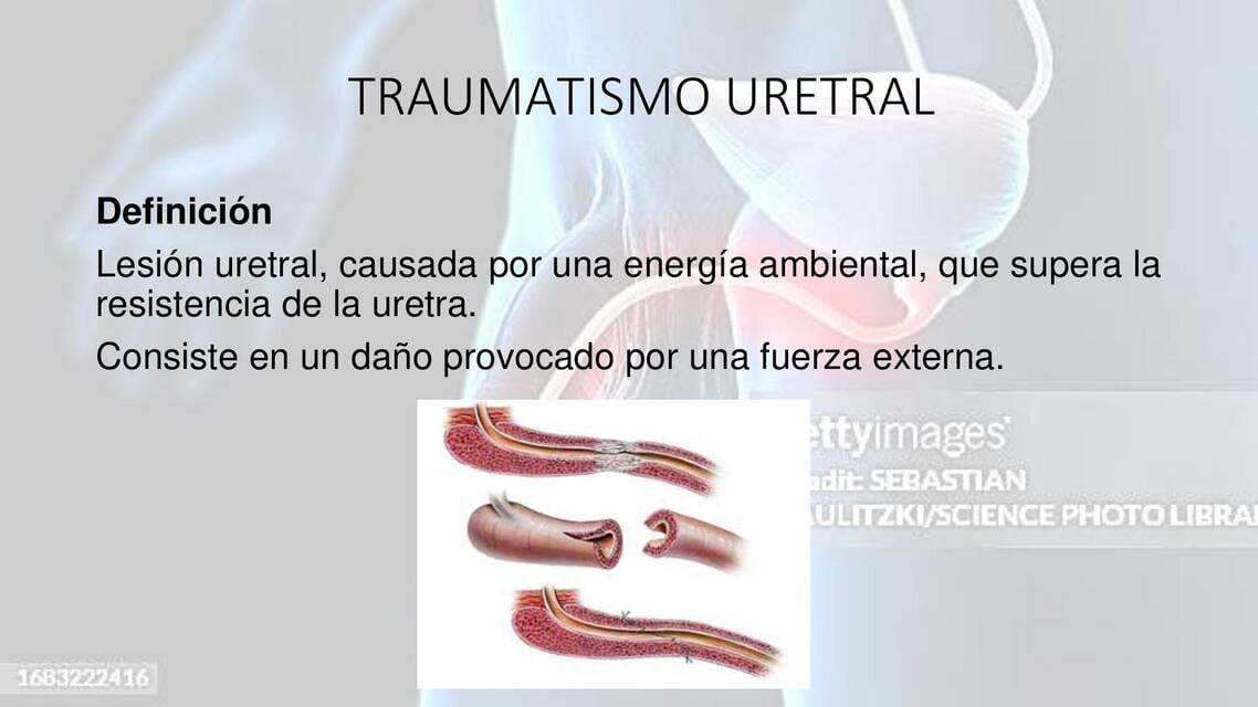 traumatismo uretral | Amelia | uDocz