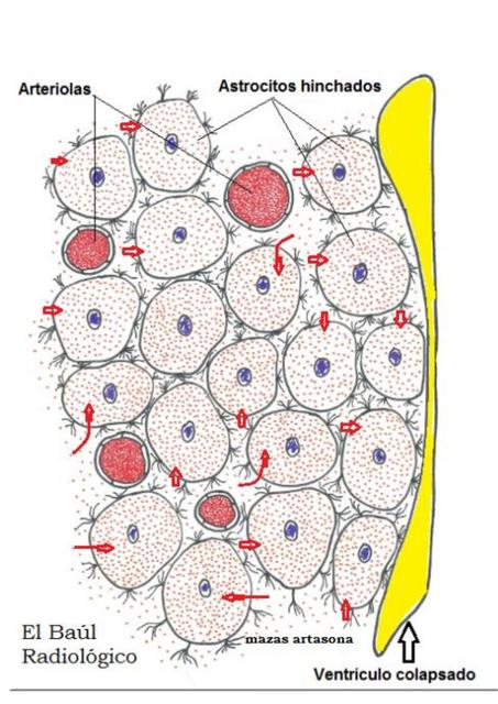 Que Es Edema Intercelular Que Es Edema Intercelular