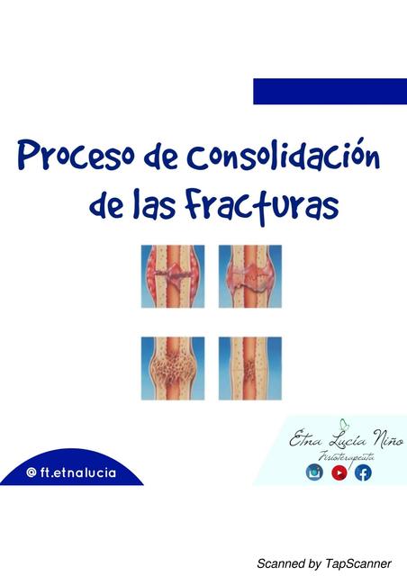 Consolidación de las fracturas