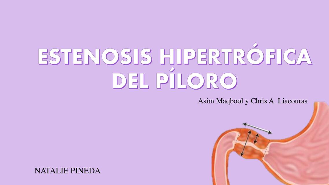 ESTENOSIS HIPERTRÓFICA DEL PÍLORO | Pineda | uDocz