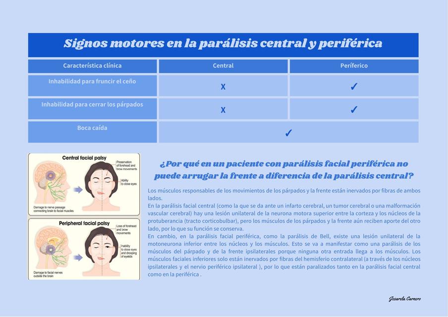 Parálisis central vs periférica