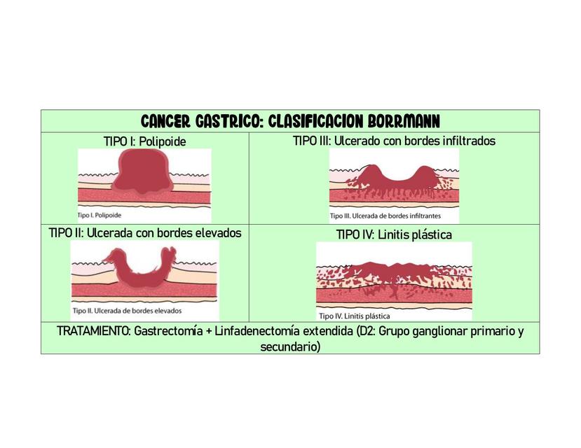 Resúmenes De Cáncer De Estómago Descarga Apuntes De Cáncer De Estómago 1107