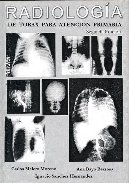 Radiología de Torax para Atención