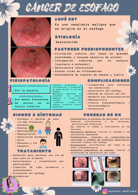 Cancer De Esofago Cancer De Esofago Oncologia Udocz