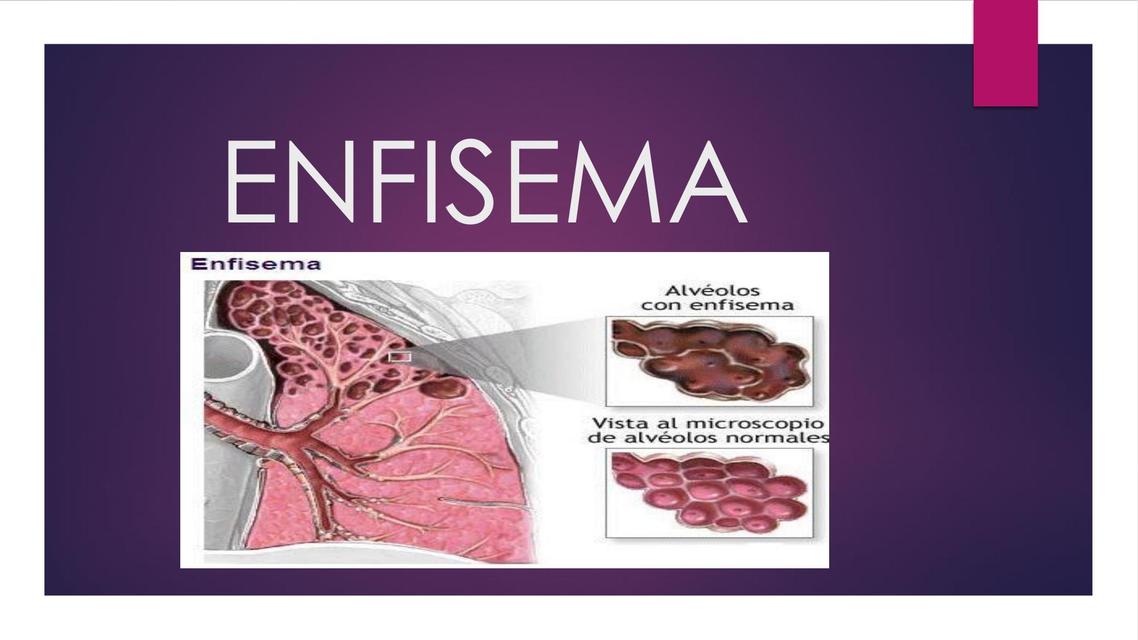 Enfisema