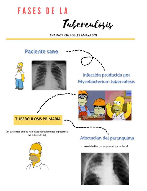 Fases de la tuberculosis (imágenes radiológicas)