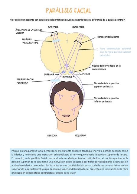 Parálisis Facial