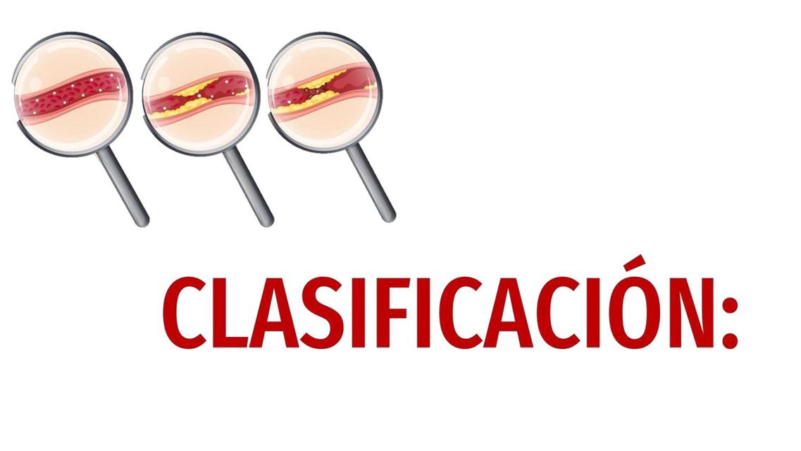 Clasificación de la Arterioesclerosis