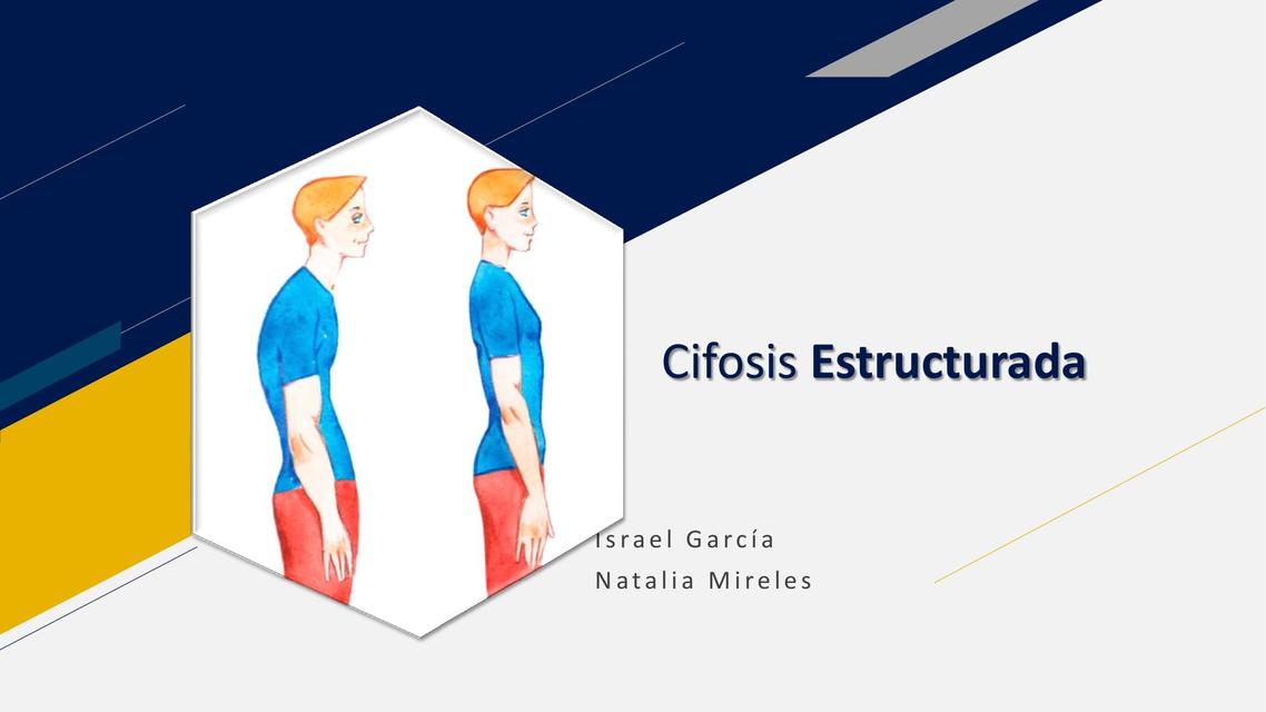 Cifosis Estructurada