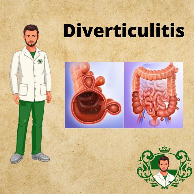 Diverticulitis