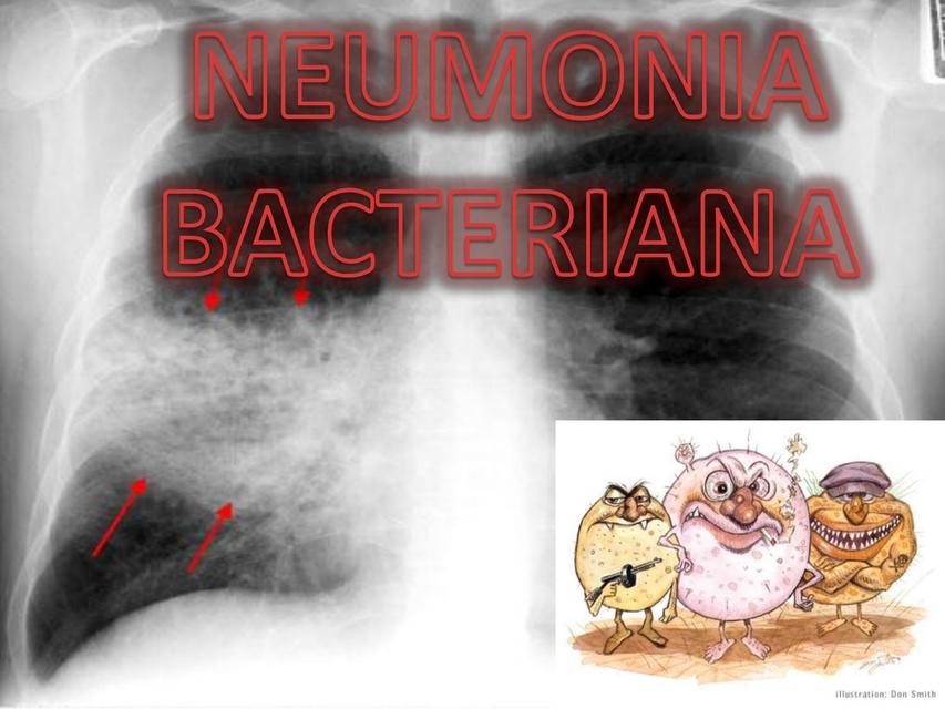 Neumonia Bacteriana