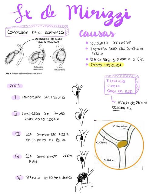 Síndrome de Mirizzi | Medicina | Síndrome de Mirizzi | uDocz