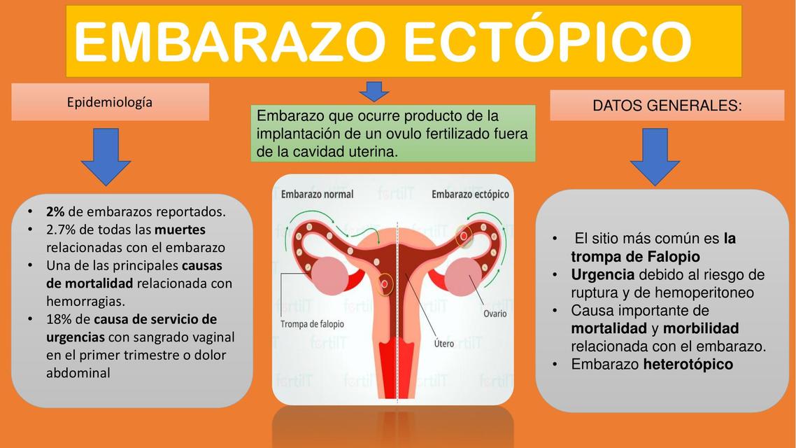 Embarazo Ectópico 