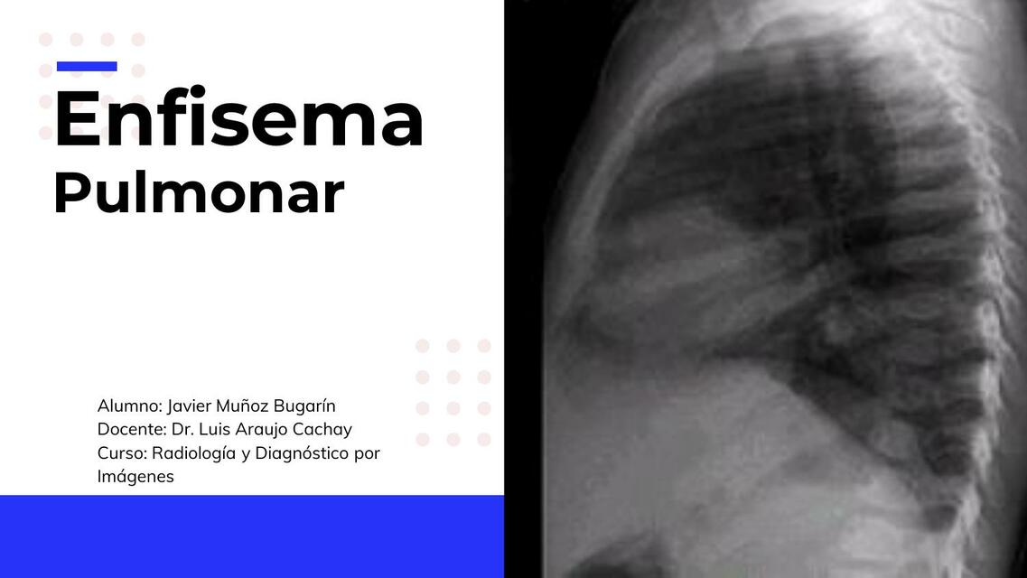 Enfisema Pulmonar