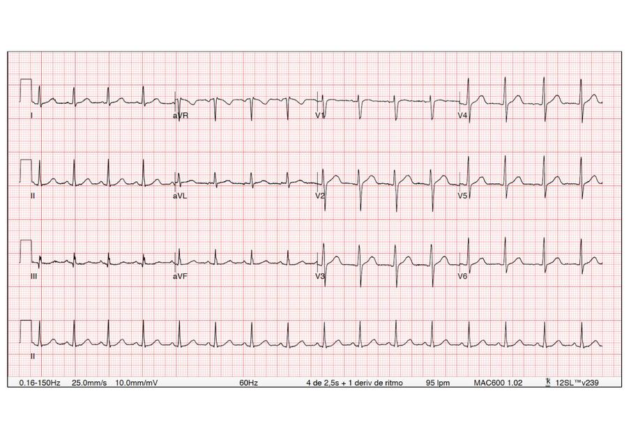 Ejemplos EKG