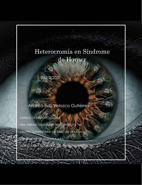 Heterocromía en Síndrome de Horner