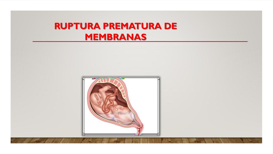 Ruptura Prematura de Membranas