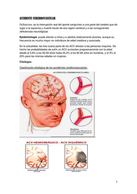 Accidente cerebrovascular