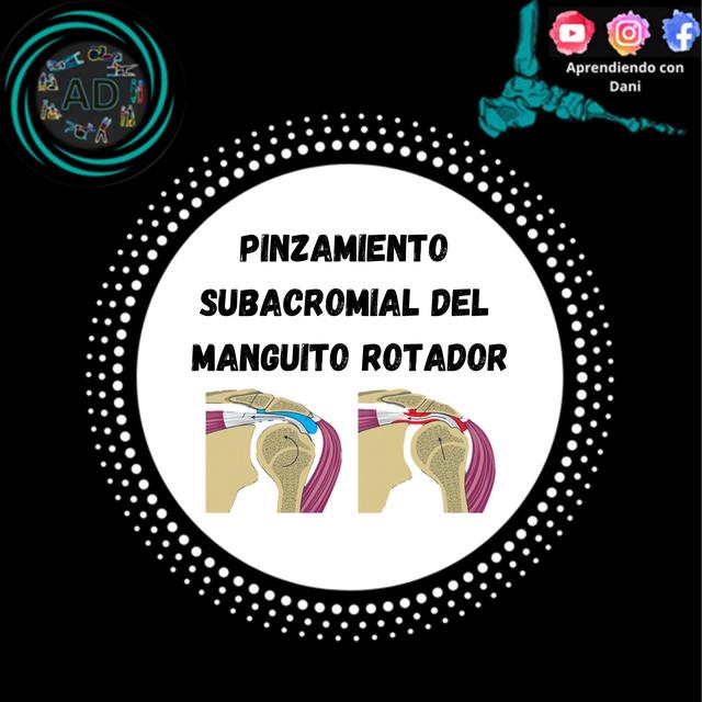 Pinzamiento  Subacromial  del  Manguito Rotador