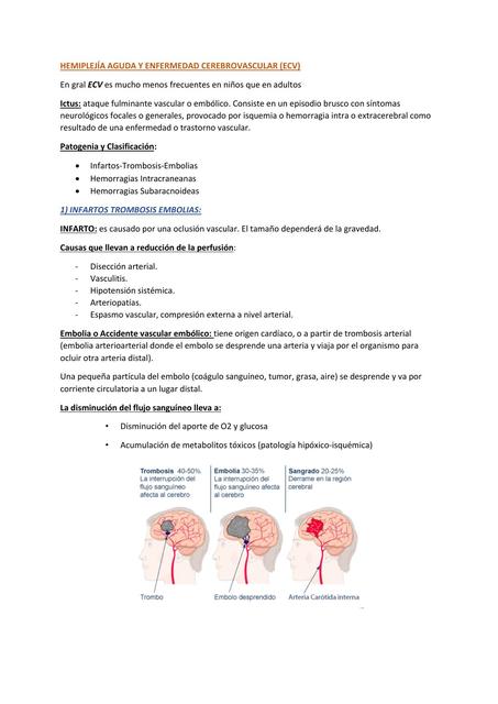 Hemiplejía aguda 