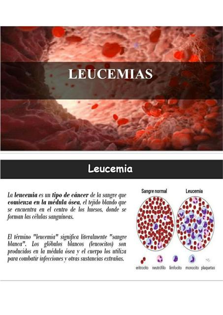 Leucemias